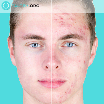 Botox gegen Akne ganzes Gesicht