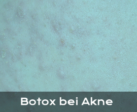 Informationen Botox bei Akne