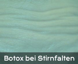 Informationen Botox bei Stirnfalten